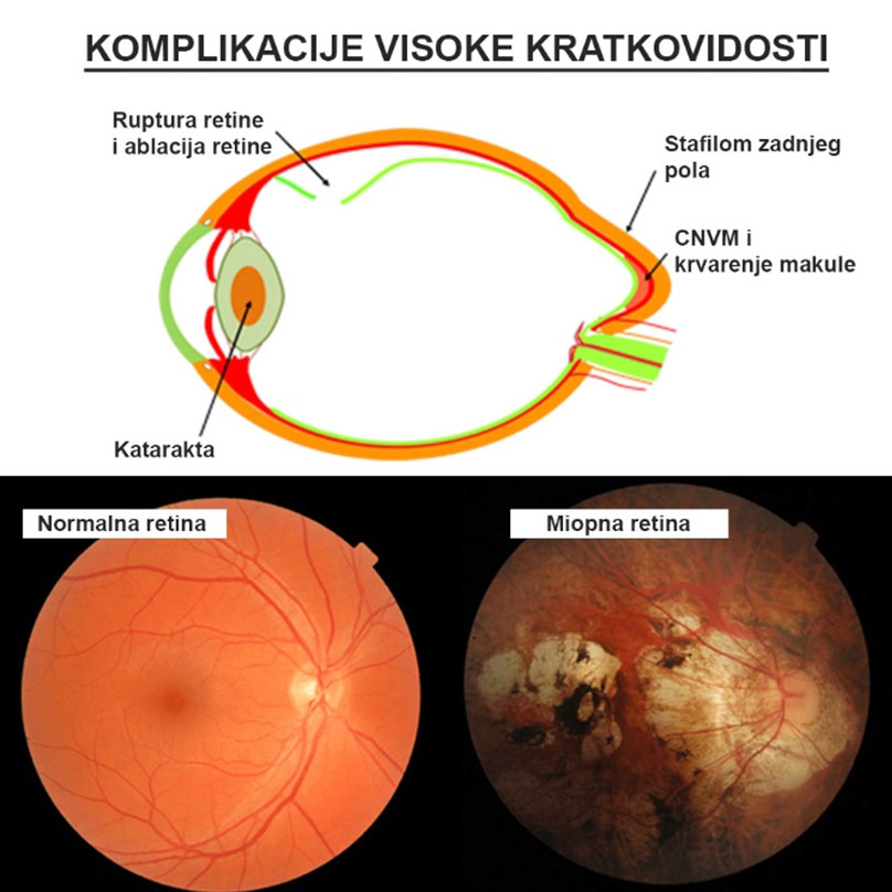 Myopia is not just vision correction by wearing glasses and contact lenses, dr Sandra Jovanović