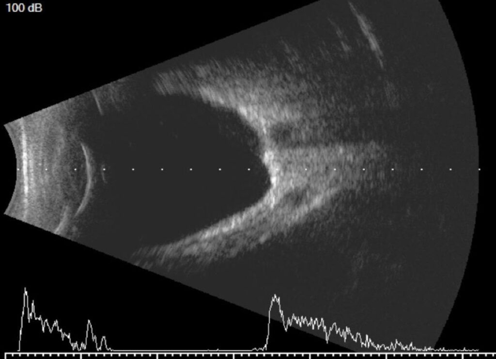 Ultrasound in ophthalmology dr Sandra Jovanović