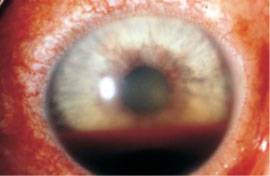 Najteže stanje u oftalmologiji &#8211; neovaskularni glaukom, dr Sandra Jovanović