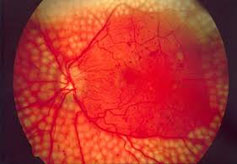 Najteže stanje u oftalmologiji &#8211; neovaskularni glaukom, dr Sandra Jovanović