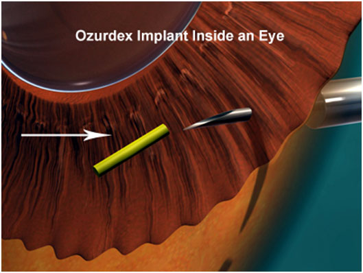 Use of intraocular implants in the treatment of diseases of the posterior segment of the eyea, dr Sandra Jovanović